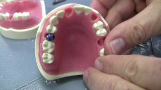 Premolar dental implant [upl. by Sile202]