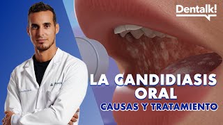 ¿HONGOS en la BOCA Causas prevención y tratamiento de la CANDIDIASIS oral y BOQUERAS  Dentalk © [upl. by Ayekim]