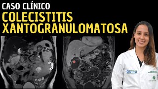 Caso clínico 110 Colecistitis xantogranulomatosa [upl. by Oinigih715]