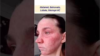 Melamet Betnovate Lobate MemopiHC Skinlite Skin Shine Lomela स्टीरोइड cream के उदाहरण हैं [upl. by Alemrac]