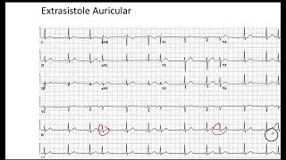 Extrasistole Auricular EKG [upl. by Adiuqram45]