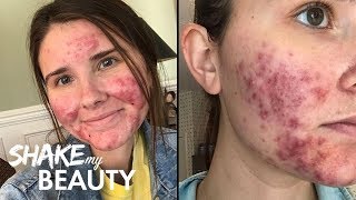 Going Out With My Severe Acne For The First Time  SHAKE MY BEAUTY [upl. by Chappy]