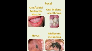 8 Focal melanosis [upl. by Ledoux]