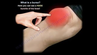 What Is BURSITIS  Everything You Need To Know  Dr Nabil Ebraheim [upl. by Daenis67]