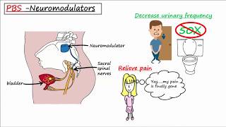 Painful Bladder Syndrome PBS  Interstitial Cystitis IC [upl. by Anaderol929]