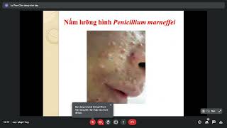 Nấm lưỡng hình Penicillium marneffei Ký sinh trùng Y2 [upl. by Eirellav171]