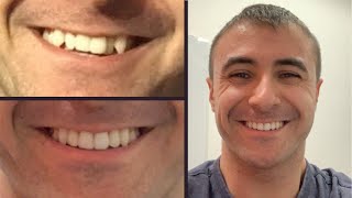 INVISALIGN REVIEW The Pros Cons Process and Price [upl. by Leopoldine]