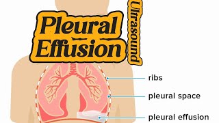 How to Ultrasound Pleural Effusion  Free Fluid in BL Lungs  Chest Lung Ultrasound [upl. by Blancha]