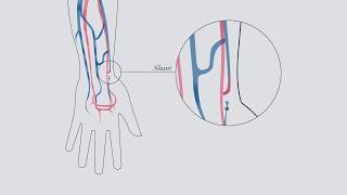 Understanding hemodialysis [upl. by Rochell]