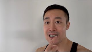 UNDERBITE JAW SURGERY VLOG 25  Week 6 Recovery  Orthodontics Appreciation  Progress Pics [upl. by Corder948]