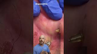 This is an iconic ear cyst extraction 👂credit aguanab0ca on TT doctor satisfying viral [upl. by Trebma]