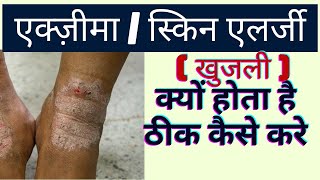 एक्जिमाखुजली eczema kya hota hai exima skin disease  eczema ka ilaj  atopic dermatitis in hindi [upl. by Atnahc]