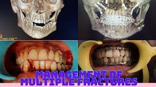 Multiple displaced Jaw fractures Fixation quotFloating Maxillaquotaesthetic maxillofacialsurgeon [upl. by Teryn]