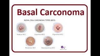 Basal Cell Carcinoma  2024 [upl. by Philomena623]