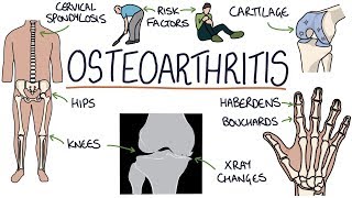 Understanding Osteoarthritis [upl. by Dom652]