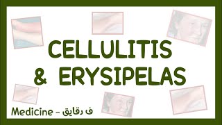 Cellulitis amp Erysipelas  clinical picture diagnosis amp treatment شرح عربي [upl. by Sherill]