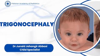 Trigonocephaly by Dr Junaid Jahangir Abbasi  Teaching on Patient [upl. by Curhan667]