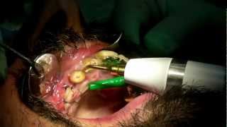 Estrazione di una radice dentale con Piezo Surgery [upl. by Netsirhc]