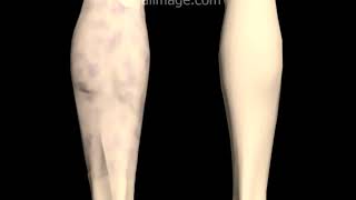 Deep Venous Thrombosis DVT Signs and Symptoms Animation by Cal Shipley MD [upl. by Sidney]