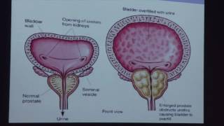 Symposium urologie 28 mei 2016  Urineretentie  Dr Jo Ampe [upl. by Marigolda]