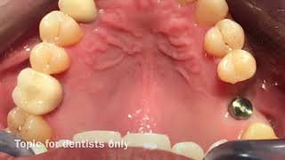 How to take Impression of Single tooth Implant [upl. by Ardnait971]