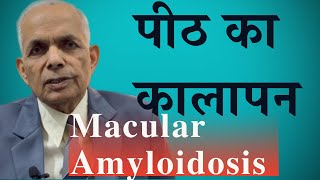 Cutaneous amyloidosis Macular amyloidosis symptoms and treatment [upl. by Ahseat275]