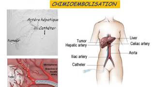 GASTROENTEROLOGIE tumeurs malignes du foie 2016 [upl. by Olra69]