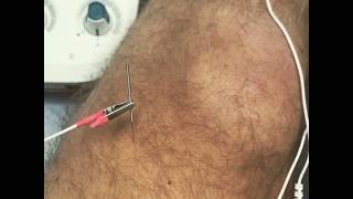 Acupuncture for Relief of Knee Pain [upl. by Zwick]