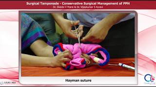 Surgical Management of PPH by Dr Sheela Mane [upl. by Oivatco]