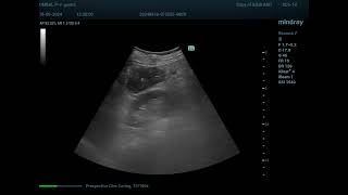 Pseudomembranous colitis [upl. by Nosmas]