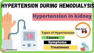 Hypertension during dialysis  intradialytic hypertensioncomplication during dialysis hemodialysis [upl. by Sterner]