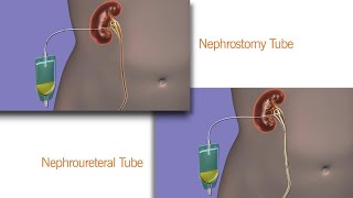 Your Nephrostomy or Nephroureteral Drain [upl. by Aseefan105]