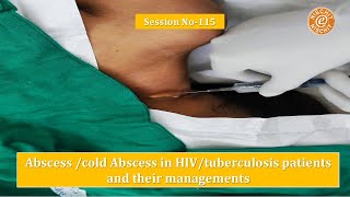 Session 115  Tuberculous Abscess in HIV patient [upl. by Chon]