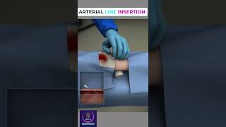 Arterial line insertion shorts [upl. by Aiciram364]