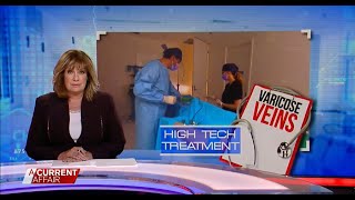 Hitech varicose vein treatments offer hope  A Current Affair [upl. by Virgil248]