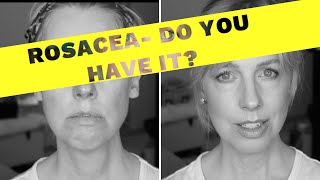 HOW TO KNOW IF YOU HAVE ROSACEA ⛔️ My 20 Year Journey from diagnosis to present day [upl. by Yessydo]