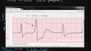 Electrocardiography Cardiac Arrhythmias [upl. by Karlise]