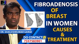 Fibroadenoma of Breast in Women Causes amp New Treatment in Telugu  Citi Vascular Centre [upl. by Eessac396]