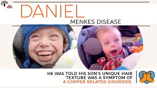 Daniel Menkes Disease [upl. by Idissak435]