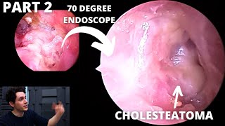 UPDATE Infected Mastoid Cavity Condylectomy Patient Is Back PART 2 ANGLED ENDOSCOPES [upl. by Shull]