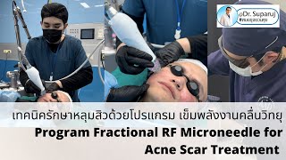 เทคนิครักษาหลุมสิวด้วยโปรแกรม เข็มพลังงานคลื่นวิทยุ Program RF Microneedle for Acne Scar Treatment [upl. by Lleroj155]