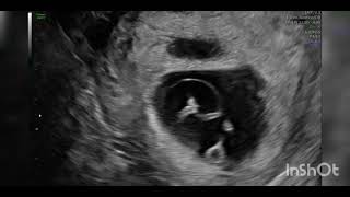 Twin reversed arterial perfusion TRAP sequence  acardia fetal ultrasound [upl. by Remington]