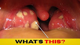 Tonsillitis Symptoms  When do you need antibiotics [upl. by Krystle]