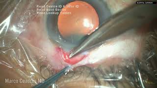 Phaco trabeculectomy unedited  Faco trabe sin editar 40 min ASMR for ophthalmologists [upl. by Hallock]