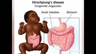 Hirschprungs Disease [upl. by Johns]