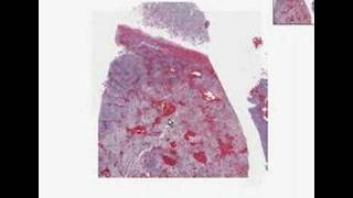 Histopathology Brain cerebellum Medulloblastoma [upl. by Florencia]