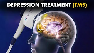 How Transcranial Magnetic Stimulation TMS Is Performed To Treat Depression [upl. by Diena925]