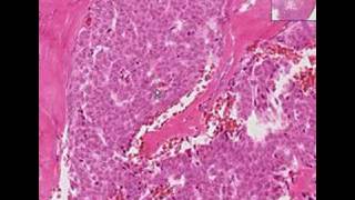 Histopathology OvaryGranulosa cell tumor [upl. by Ilana]