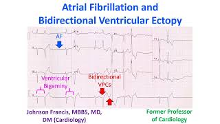 Atrial Fibrillation and Bidirectional Ventricular Ectopy [upl. by Cullen664]