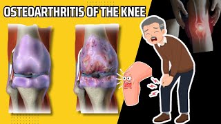 The Complete Guide to Osteoarthritis Symptoms Causes and Treatments for Knee Joints Notes [upl. by Lotta259]